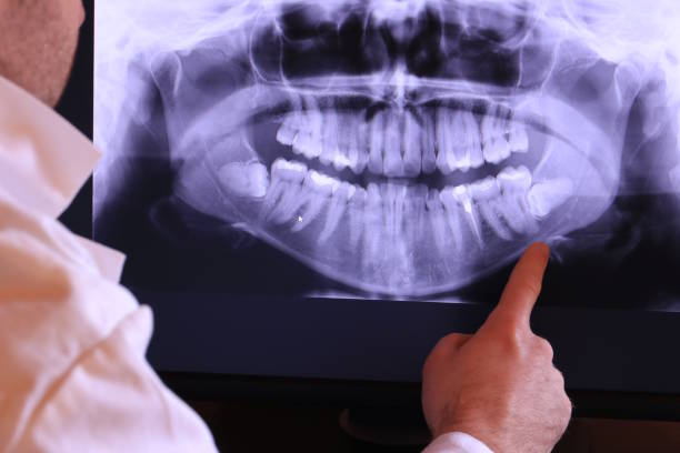 Best Emergency Tooth Extraction in Alexandria, LA