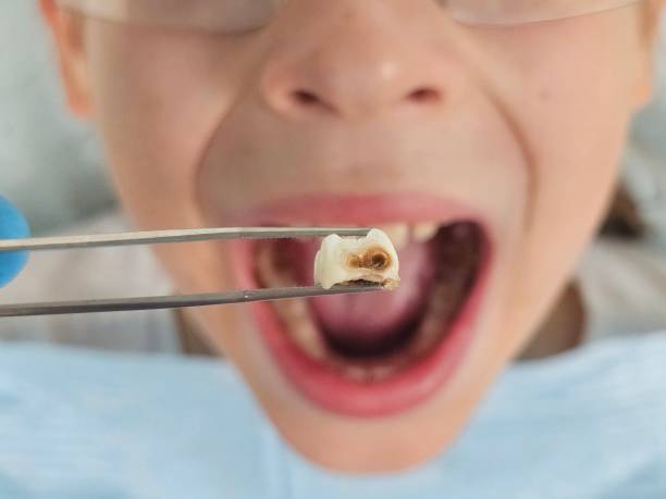 Best Emergency Tooth Extraction in Alexandria, LA